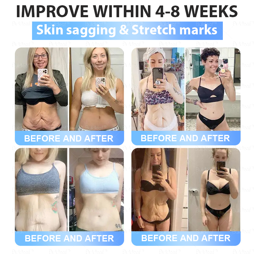 🏥𝐅𝐃𝐀 𝐒𝐭𝐨𝐫𝐞 | 𝐁𝐮𝐢𝐥𝐝𝑳𝒆𝒂𝒇® 𝑮𝓛𝓟-1 𝑵𝒂𝒏𝒐-𝑴𝒊𝒄𝒓𝒐𝒏𝒆𝒆dle Pa𝑡𝑐ℎ 𝑤𝑖𝑡ℎ 𝐶𝑜𝑙𝑙𝑎𝑔𝑒𝑛 & 𝑀𝑎𝑡𝑟𝑖𝑥𝑦𝑙 3000 丨Ob𝗲𝘀𝗶𝘁𝘆,𝐂𝐚𝐫𝐝𝐢𝐨𝐯𝐚𝐬𝐜𝐮𝐥𝐚𝐫 𝐃𝐢𝐬𝐞𝐚𝐬, 𝐃𝐢𝐚𝐛𝐞𝐭𝐞𝐬, 𝐒𝐥𝐞𝐞𝐩 𝐀𝐩𝐧𝐞𝐚, 𝐉𝐨𝐢𝐧𝐭 𝐏𝐫𝐨𝐛𝐥𝐞𝐦𝐬 𝐚𝐧𝐝 𝐌𝐨𝐫𝐞