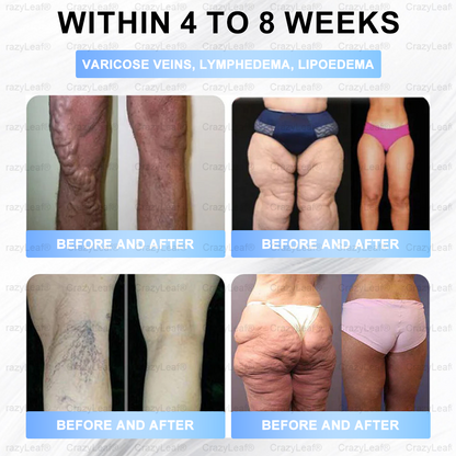 🏥𝐅𝐃𝐀 𝐒𝐭𝐨𝐫𝐞 | 𝐁𝐮𝐢𝐥𝐝𝑳𝒆𝒂𝒇® 𝑮𝓛𝓟-1 𝑵𝒂𝒏𝒐-𝑴𝒊𝒄𝒓𝒐𝒏𝒆𝒆dle Pa𝑡𝑐ℎ 𝑤𝑖𝑡ℎ 𝐶𝑜𝑙𝑙𝑎𝑔𝑒𝑛 & 𝑀𝑎𝑡𝑟𝑖𝑥𝑦𝑙 3000 丨Ob𝗲𝘀𝗶𝘁𝘆,𝐂𝐚𝐫𝐝𝐢𝐨𝐯𝐚𝐬𝐜𝐮𝐥𝐚𝐫 𝐃𝐢𝐬𝐞𝐚𝐬, 𝐃𝐢𝐚𝐛𝐞𝐭𝐞𝐬, 𝐒𝐥𝐞𝐞𝐩 𝐀𝐩𝐧𝐞𝐚, 𝐉𝐨𝐢𝐧𝐭 𝐏𝐫𝐨𝐛𝐥𝐞𝐦𝐬 𝐚𝐧𝐝 𝐌𝐨𝐫𝐞